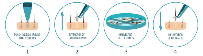 fue-transplant-hair-loss-treatment