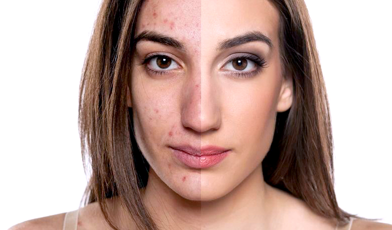 how_to_get_rid_of_acne_scars_1024x1024