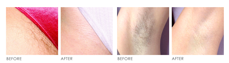 laser hair removal Before After 01
