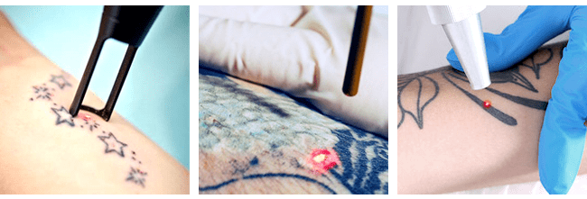 laser tattoo removal