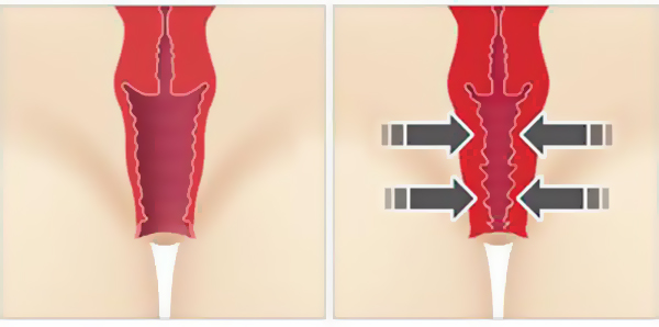 Laser Vaginal Tightening (LVT) 