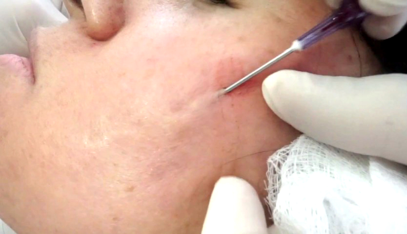 Subcision