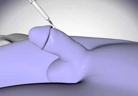 penis enlargement by fillers