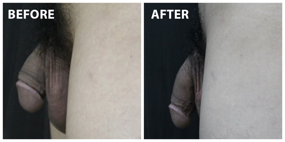 Penis Enlargement Before & After KL