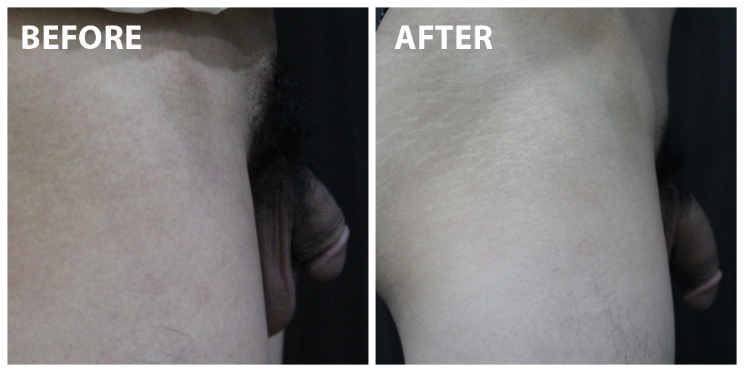 Penis Enlargement Before & After KL