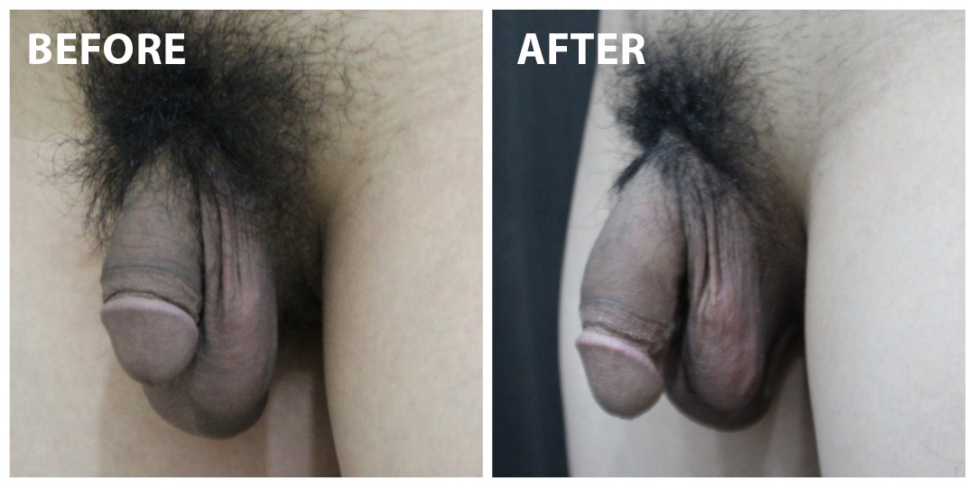 Penis Enlargement Before & After KL