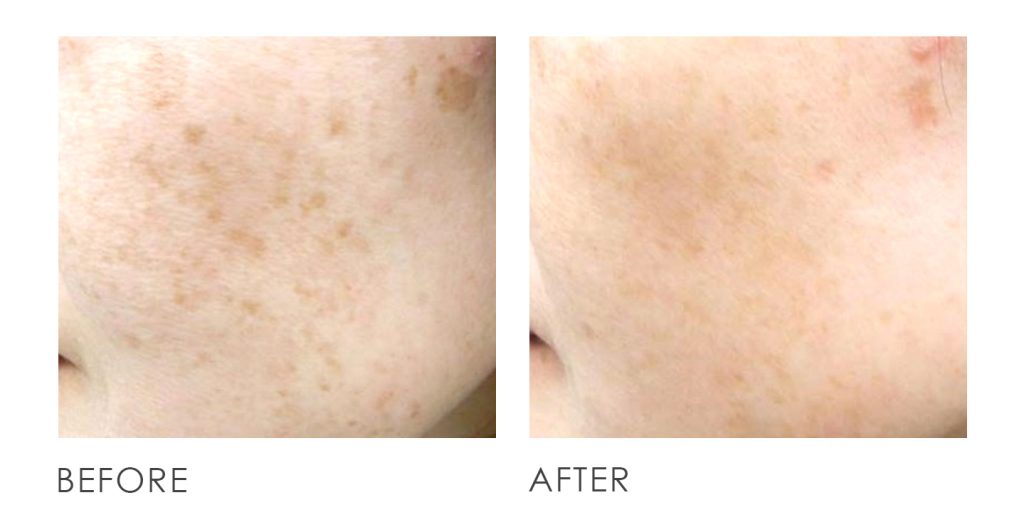 pigmentation q switch laser