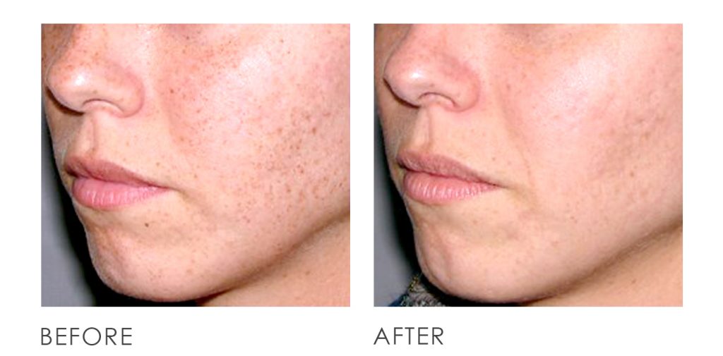 pigmentation q switch laser