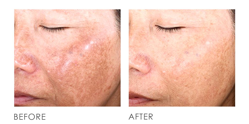 pigmentation q switch laser