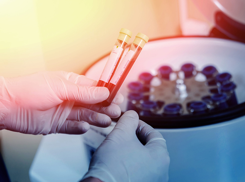 Platelet-Rich Plasma Facial Therapy