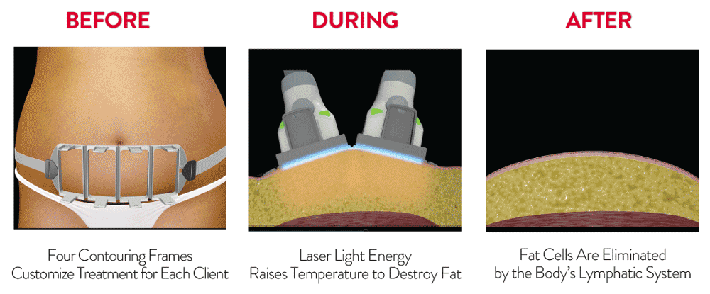 le shape slimming