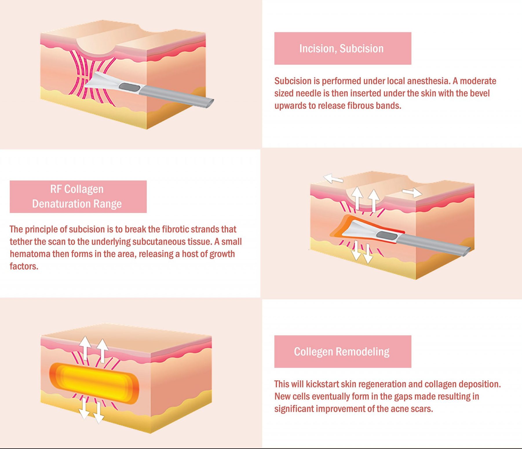 WHAT IS SUBCISION AND HOW IS IT DONE?
