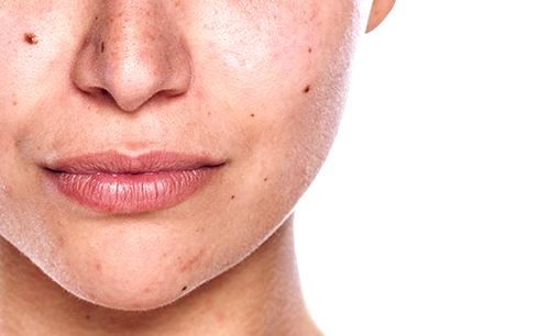 Skin Discoloration