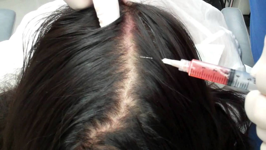 Stem Cell Treatment for Hair Loss