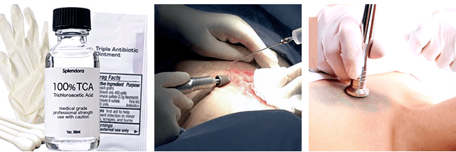 tattoo removal procedures
