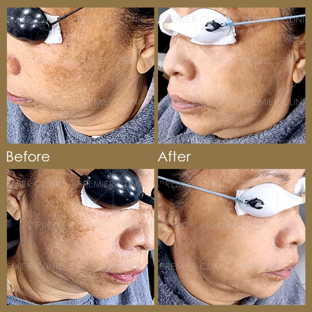 Pigmentation Removal Laser Before & After 