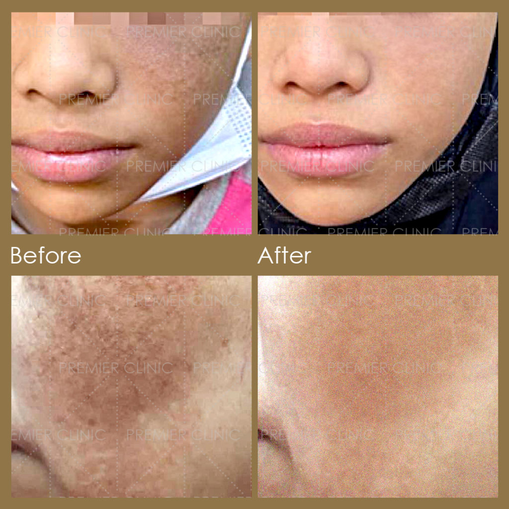 Pigmentation Removal Laser Before & After 