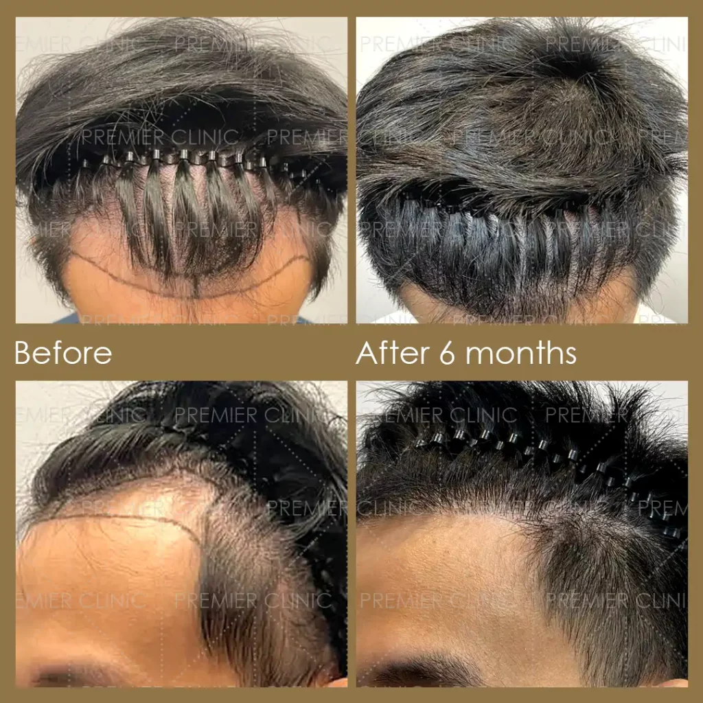 Premier FUE Hair Transplant Before & After procedure - Natural-looking Results