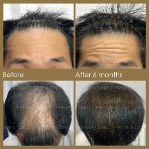 Premier FUE Hair Transplant Before & After procedure - Natural-looking Results
