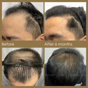 Premier FUE Hair Transplant Before & After procedure - Natural-looking Results