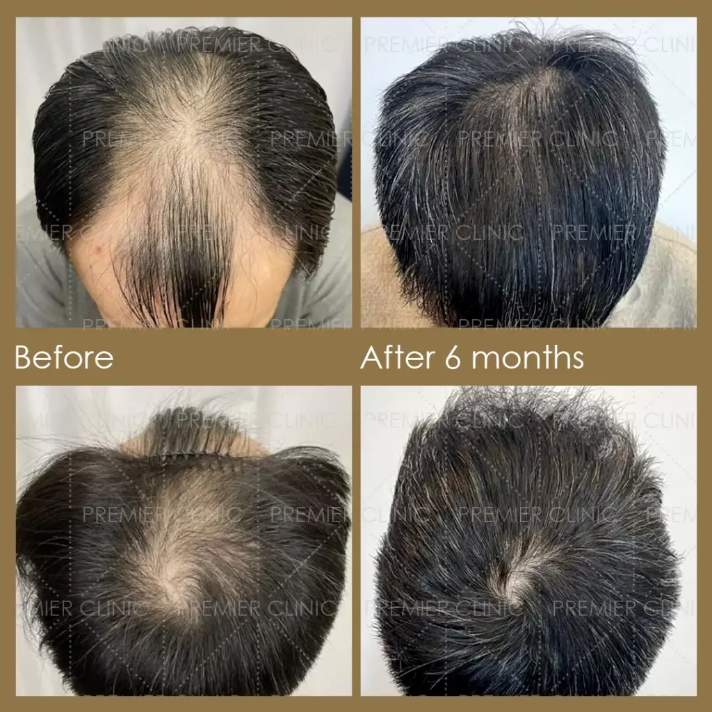 Premier FUE Hair Transplant Before & After procedure - Natural-looking Results