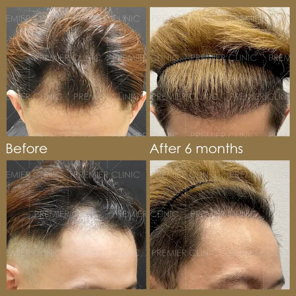 Premier FUE Hair Transplant Before & After procedure - Natural-looking Results 