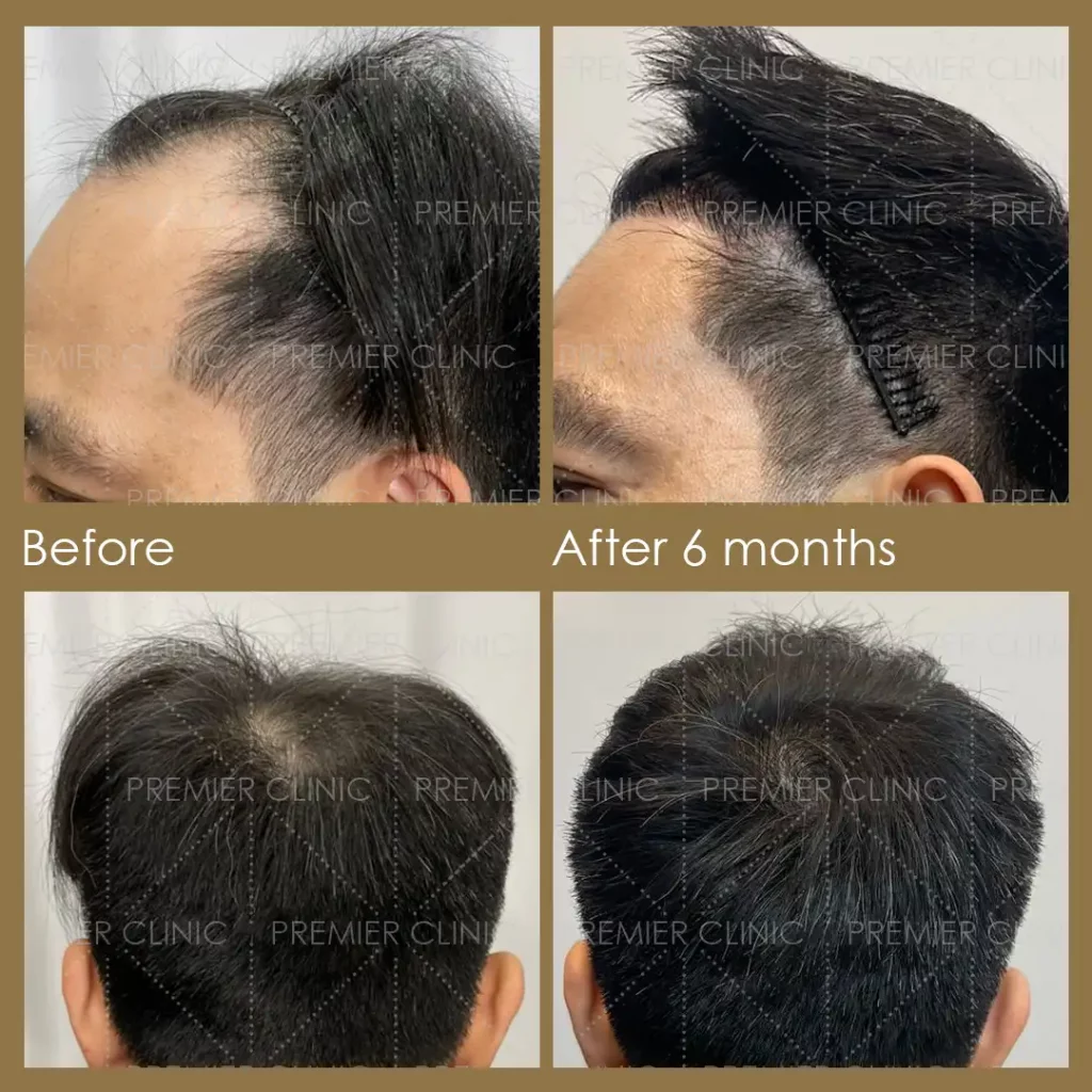 Premier FUE Hair Transplant Before & After procedure - Natural-looking Results 