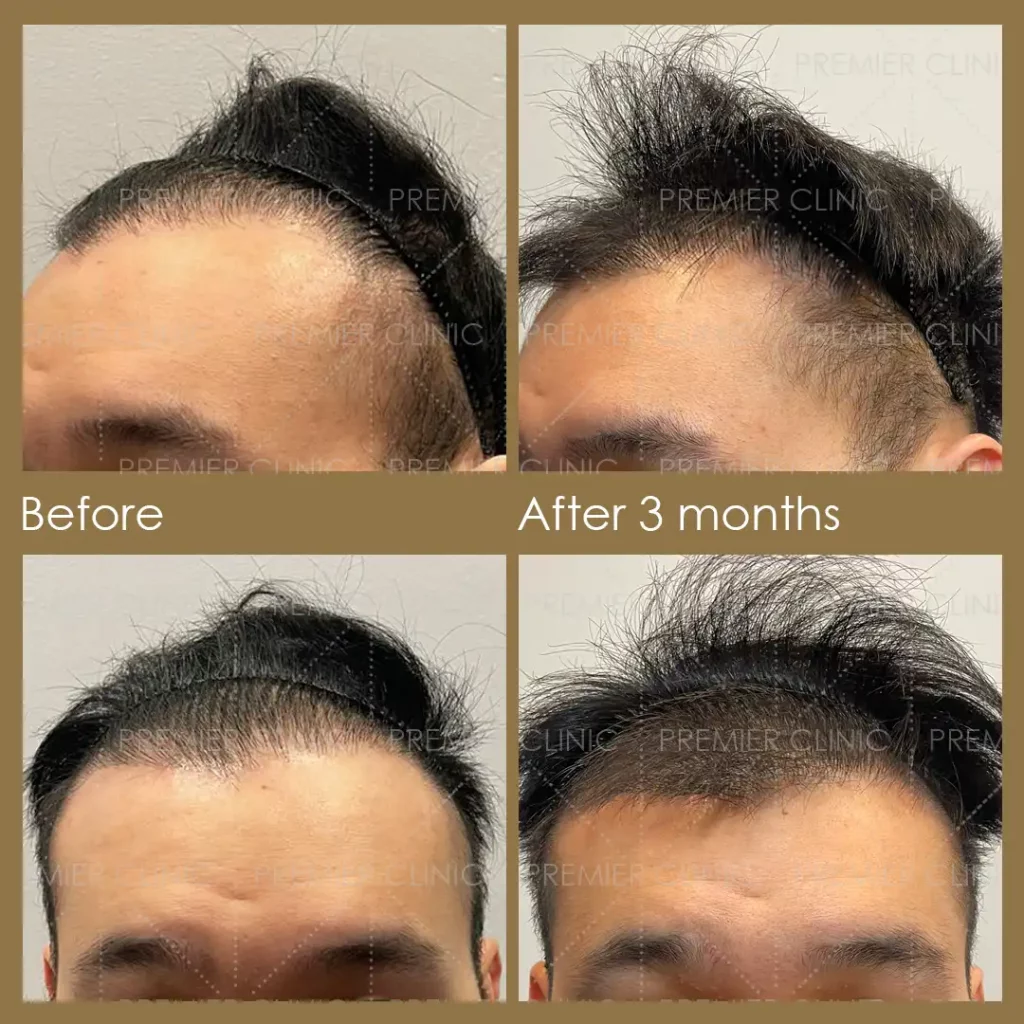 Premier FUE Hair Transplant Before & After procedure - Natural-looking Results 