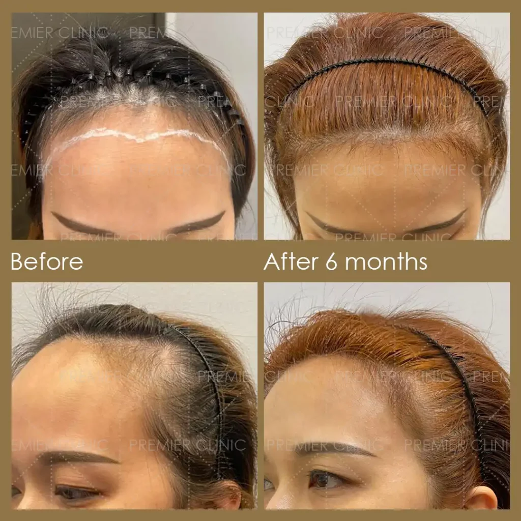 Premier FUE Hair Transplant Before & After procedure - Natural-looking Results 
