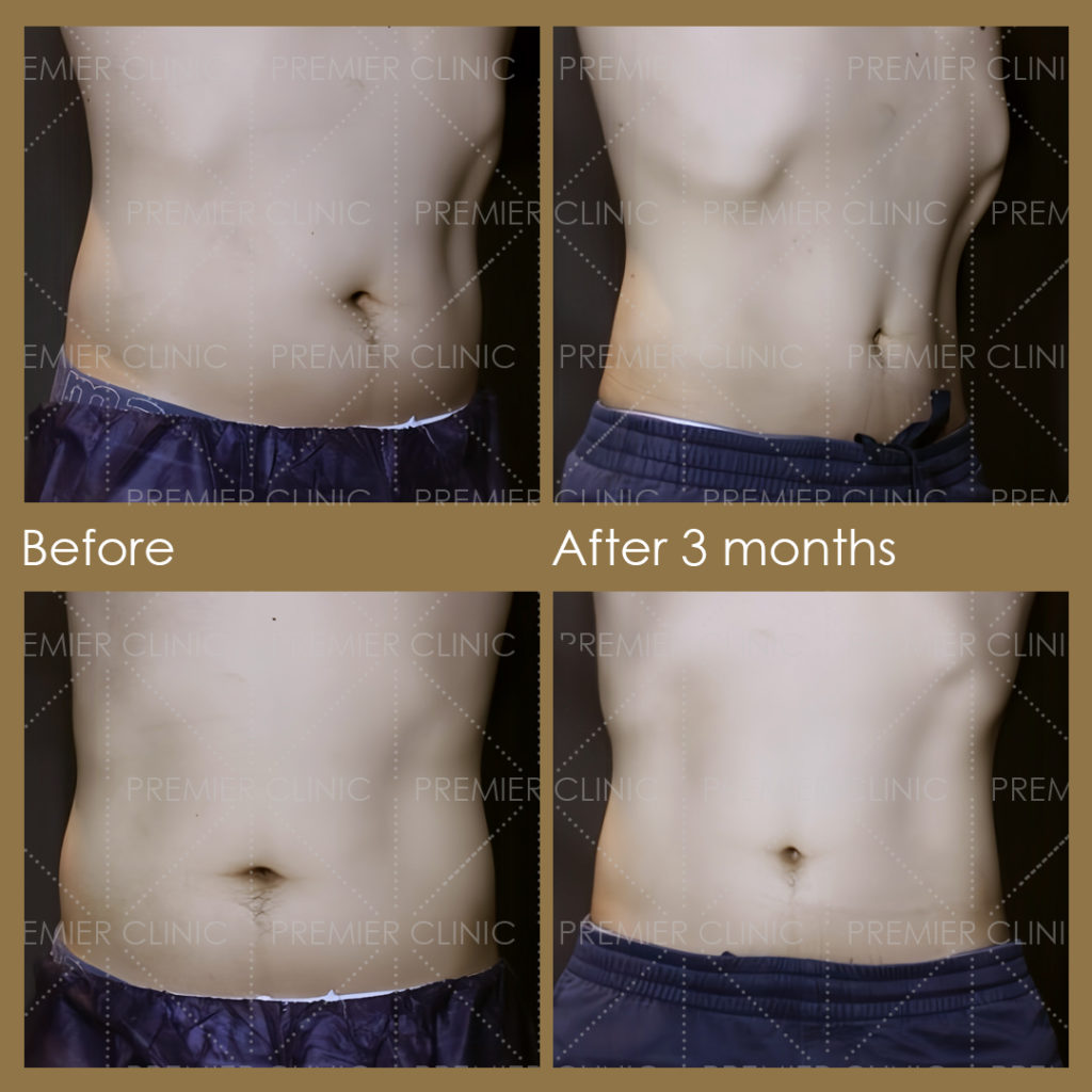  Premier Fat Loss Before & After 