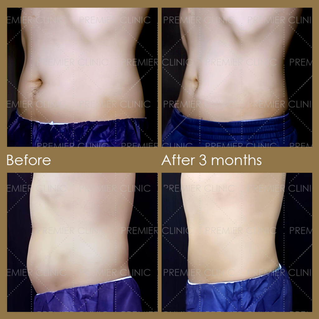  Premier Fat Loss Before & After 