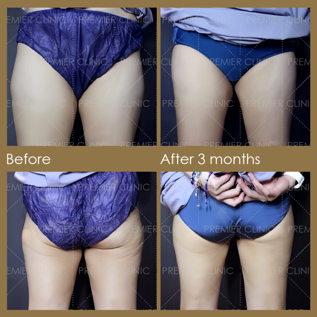  Premier Fat Loss Before & After 