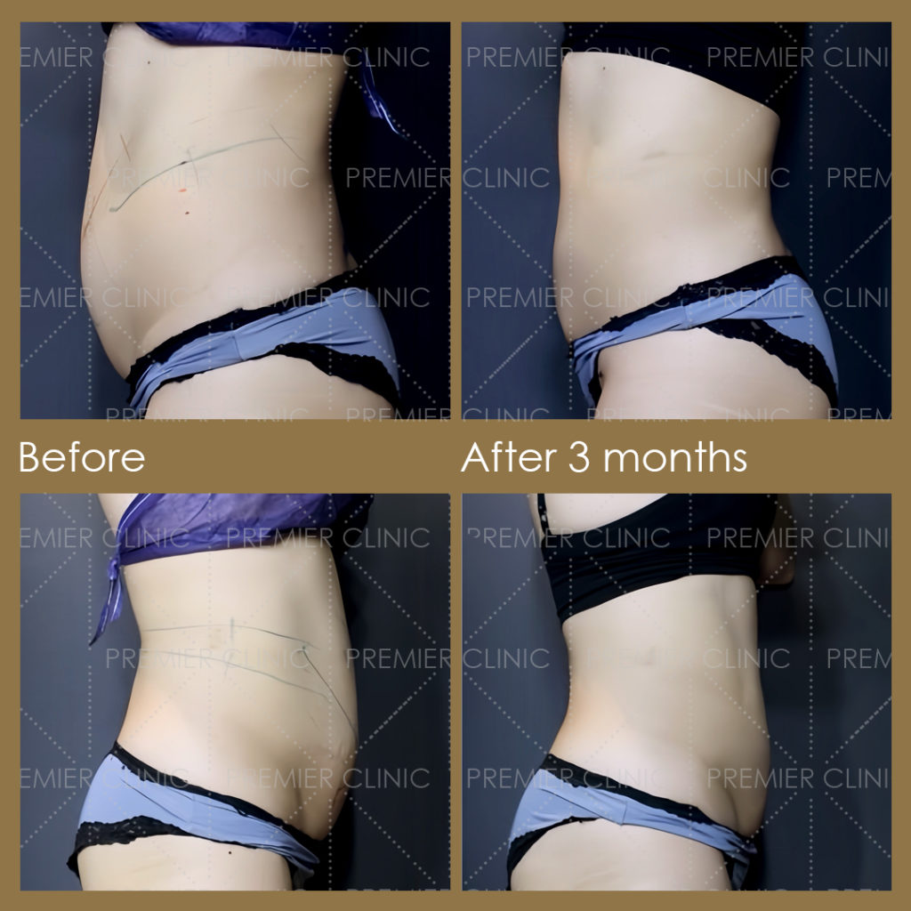  Premier Fat Loss Before & After 