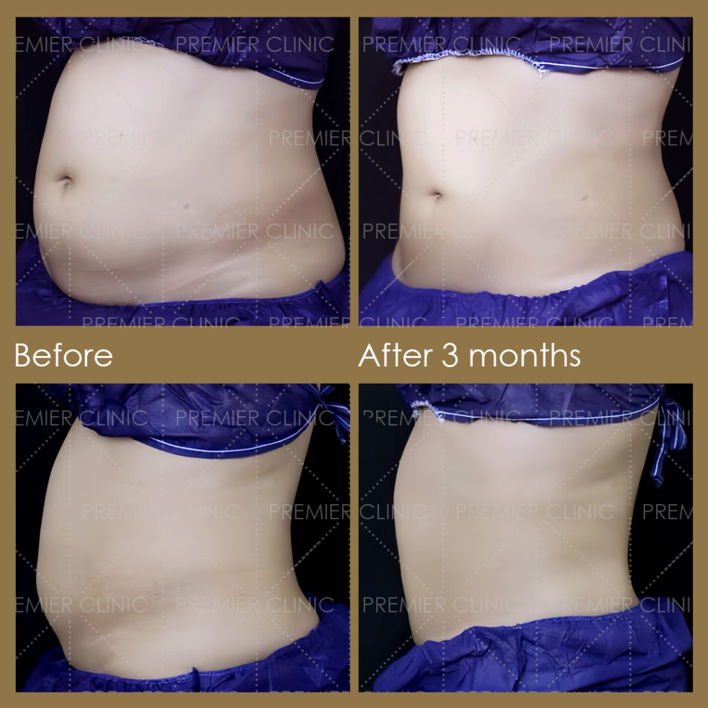  Premier Fat Loss Before & After 