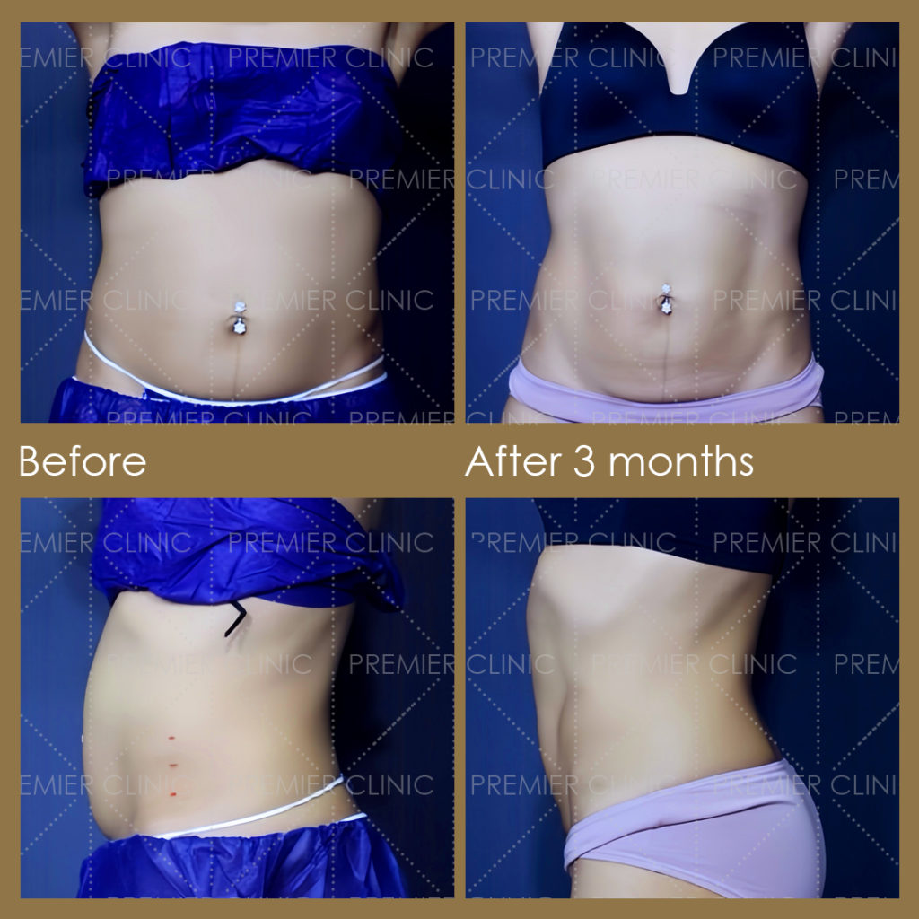  Premier Fat Loss Before & After 