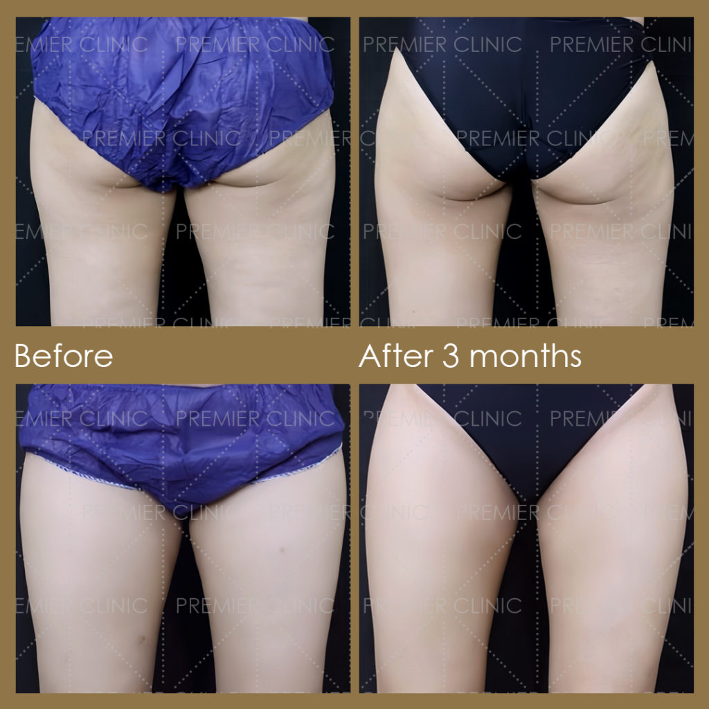  Premier Fat Loss Before & After 