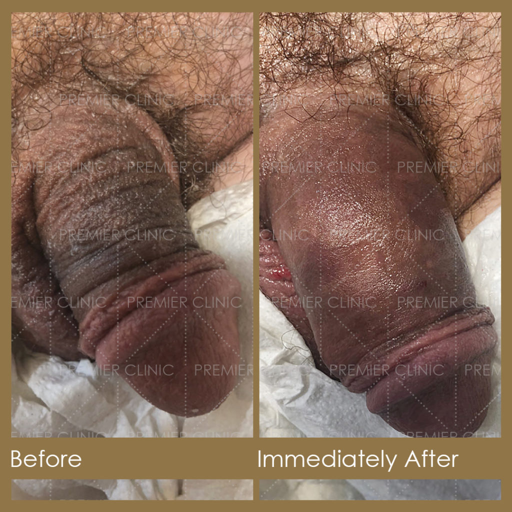 Premier Penis Enlargement Filler Injection Before & After Results