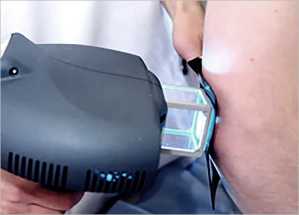  UVB Therapy 