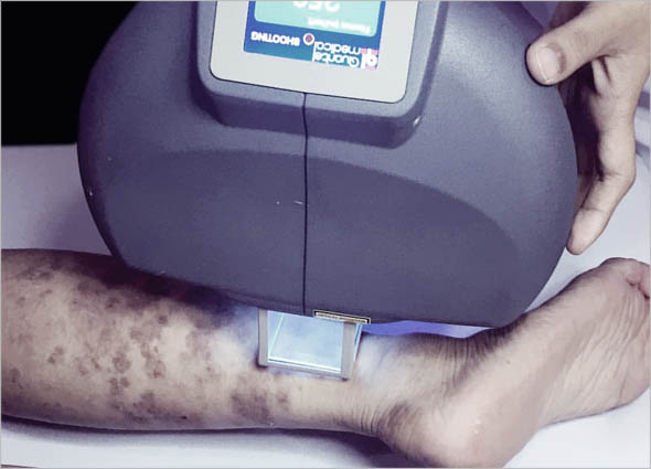  UVB Therapy 