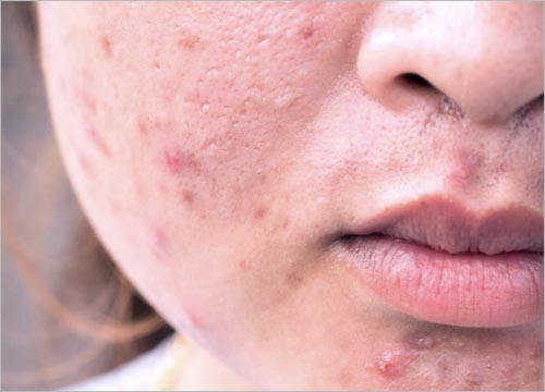 Acne Scars