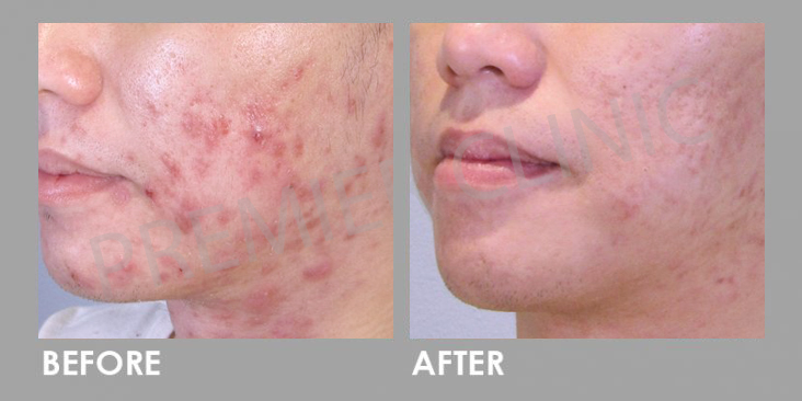 Chemical Skin Peel Treatment