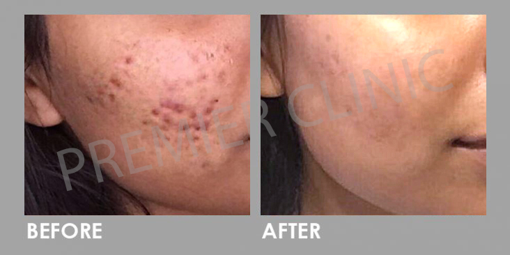 Platelet-rich Plasma (PRP)