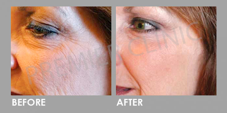 Bioidentical Hormones Replacement Therapy
