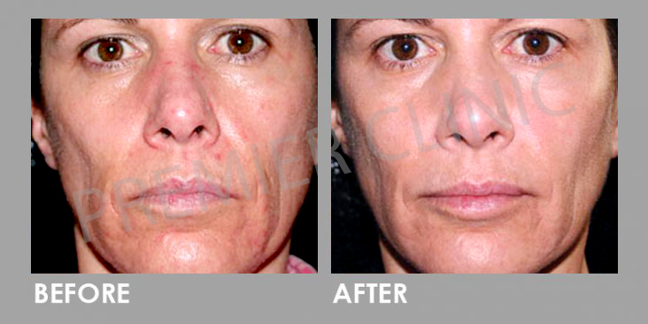 Bioidentical Hormones Replacement Therapy