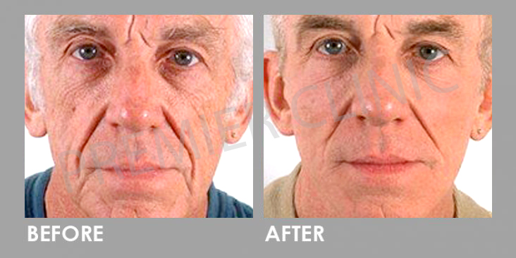 Bioidentical Hormones Replacement Therapy
