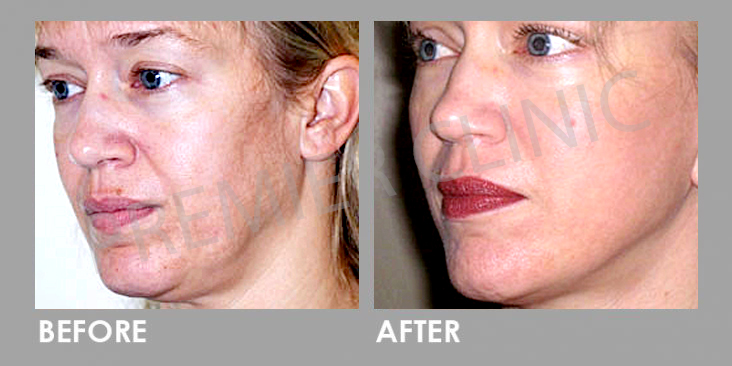 Bioidentical Hormones Replacement Therapy