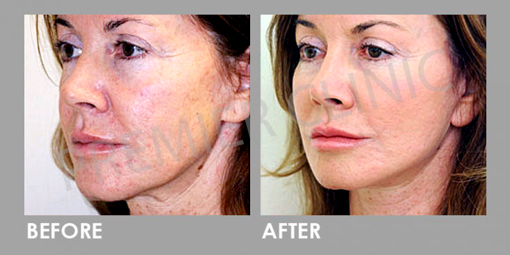 Bioidentical Hormones Replacement Therapy