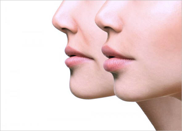 ELLANSE DERMAL FILLER