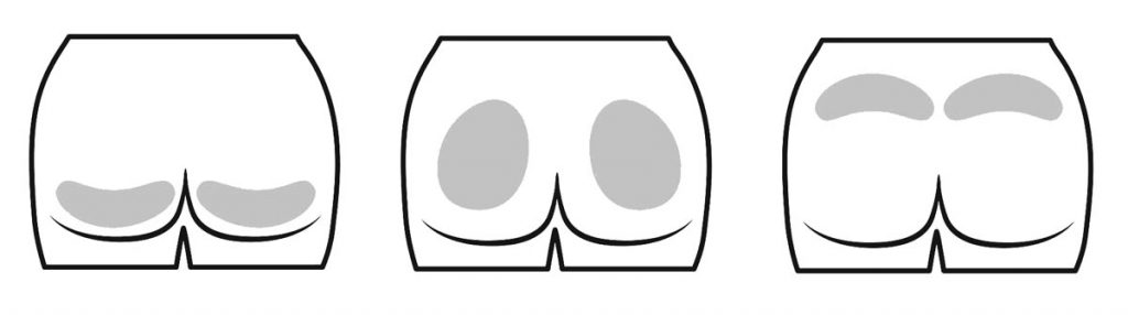 BUTTOCK INJECTION AUGMENTATION