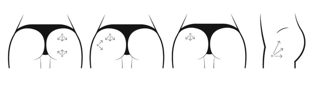 BUTTOCK INJECTION AUGMENTATION